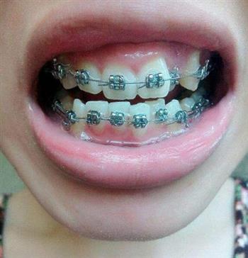 横向评比5种常见牙齿美白治疗