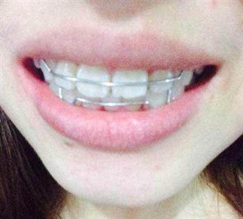 专家评牙齿美白法：不能以伤害牙釉质为代价